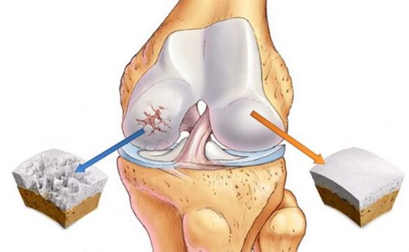 Diz ekleminin osteoartriti (solda) ve normal kıkırdak (sağda)