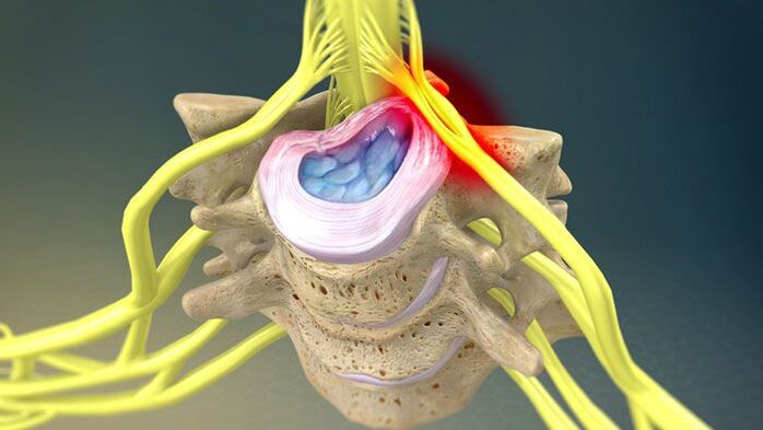 İntervertebral disk çıkıntısı boyun ağrısına neden olur